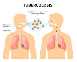 Engage private sector to fight TB — Institute