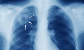 TB kills over 162,000 Nigerians annually, Thoracic society says