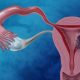 Rise in uterine cancer linked to pesticide exposure