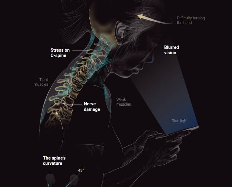 Text neck syndrome