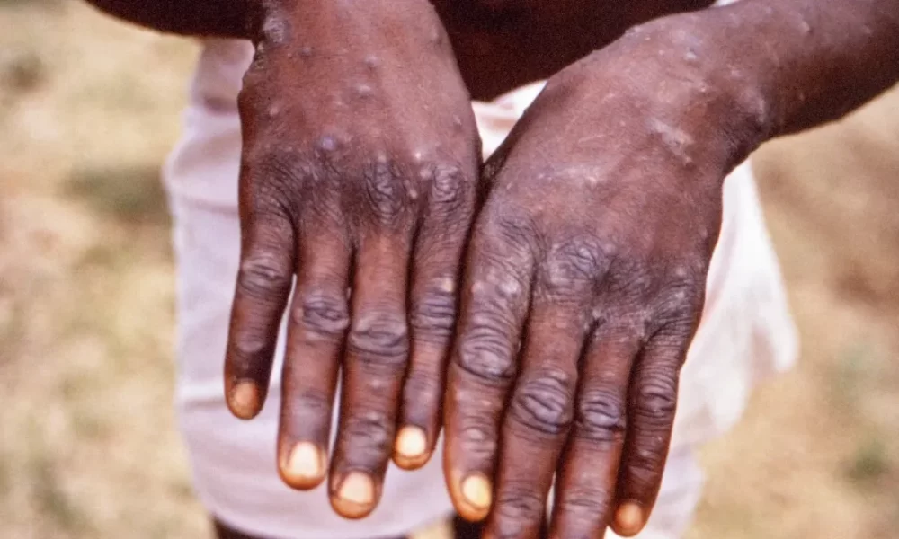 Monkeypox: Symptoms, Prevention, and Treatment