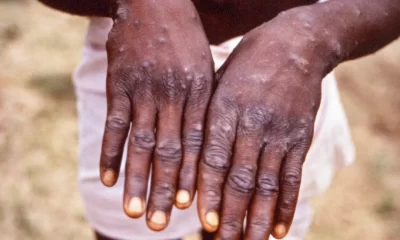 Monkeypox: Symptoms, Prevention, and Treatment