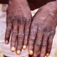 Monkeypox: Symptoms, Prevention, and Treatment