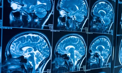 Report reveals manipulation in new Brunswick brain disease investigation