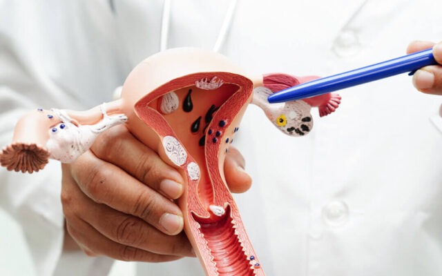 Cervical cancer is preventable and curable with early action - UN