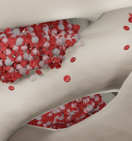 SCFN, LUTH introduce bone marrow transplants as curative treatment for sickle cell