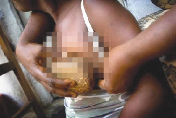 Girls in Pain: The physical, emotional cost of breast ironing rituals