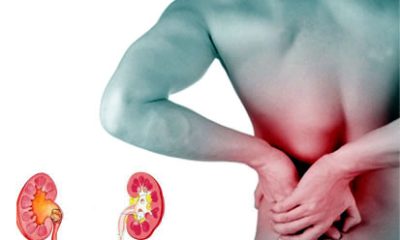 Experts warn of rising kidney disease cases linked to dehydration, painkiller misuse